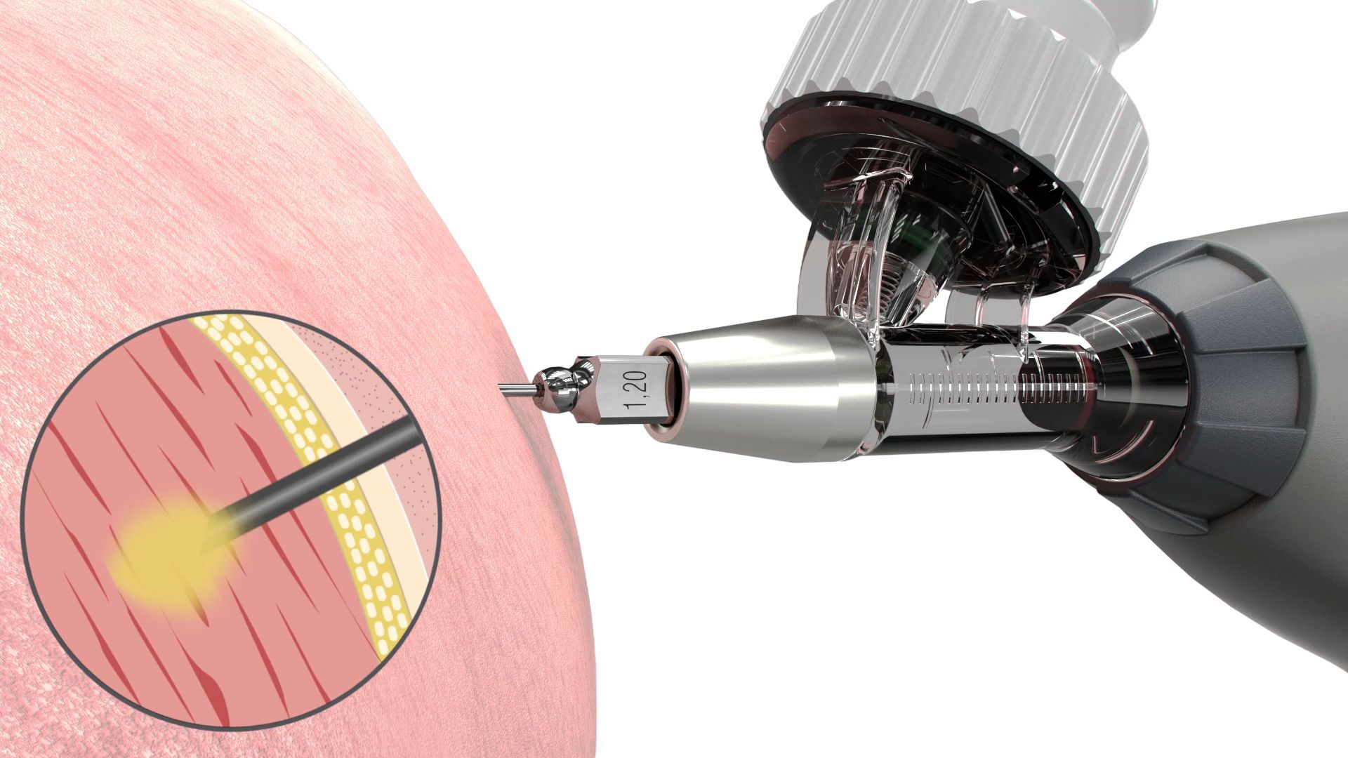 dermabrasion, micro-needle, skin treatment, cosmetic device, dermistone?, micro-needling, tissue-piercing, microsurgeon, surgical-needle, injection-device, tissue-dissecting